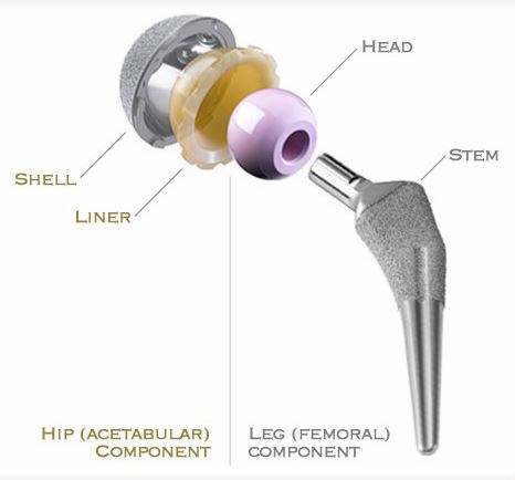 hipreplacement